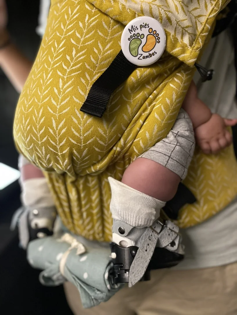Un bebé porteado en una mochila amarilla, con la férula puesta y una chapa que dice «Mis pies zambos»